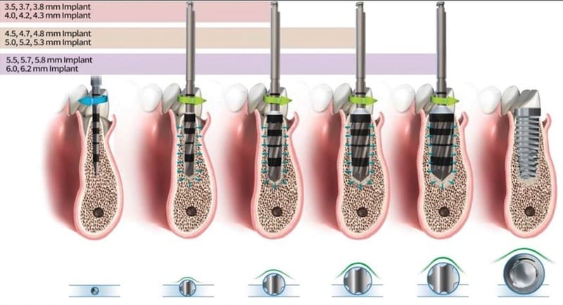 Implantate Bremen auch mit geringem Knochangebot - mittels Versah Densah Bohrern - Zahnzentrum Fluke Bremen