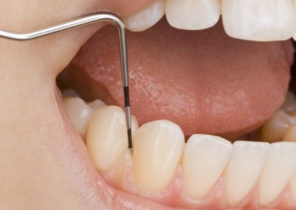Parodontosebehandlung bei Zahnfleischschwund, Zahnfleischentzündung bei Zahnarzt Bremen Nord