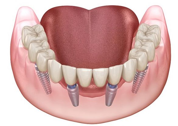 Feste neue Zähne auf 4 Implantaten, Sofortimplantate Zahnarzt Bremen Nord