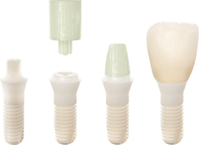 Vollkeramik Bremen: 2 teilige Keramik Implantate von Patent