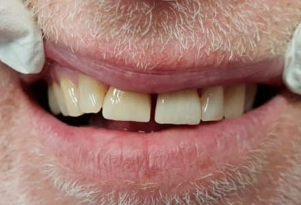Fallbeispiel nachher: eingesetzte Keramikkronen an den Frontzähnen